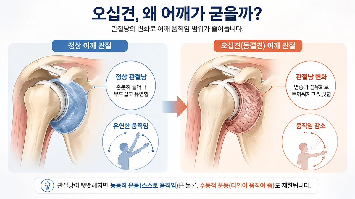 오십견에서 관절낭 변화로 어깨 운동 범위가 줄어드는 과정을 설명한 그림