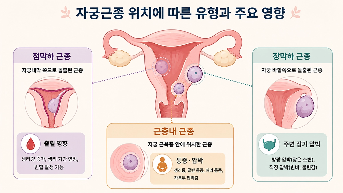 자궁근종 위치에 따른 점막하 근종과 근층내 근종, 장막하 근종 비교