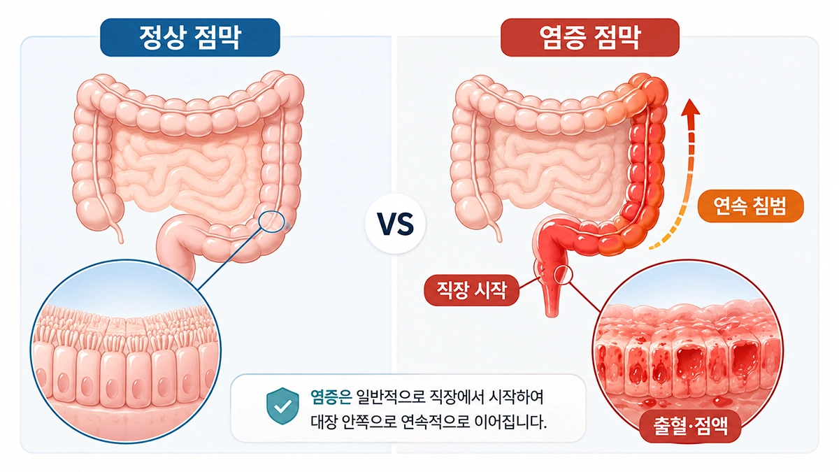 궤양성 대장염이 직장에서 시작해 대장으로 연속적으로 퍼지는 염증 범위 비교