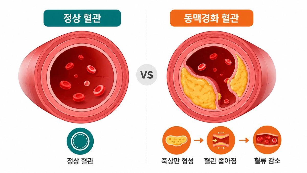 정상 혈관과 죽상판이 쌓인 동맥경화 혈관의 차이를 보여주는 인포그래픽