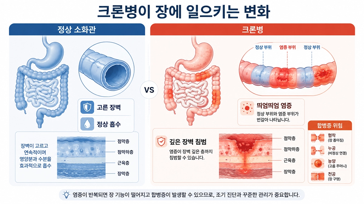 정상 소화관과 크론병의 비연속적이고 깊은 염증을 비교한 이미지