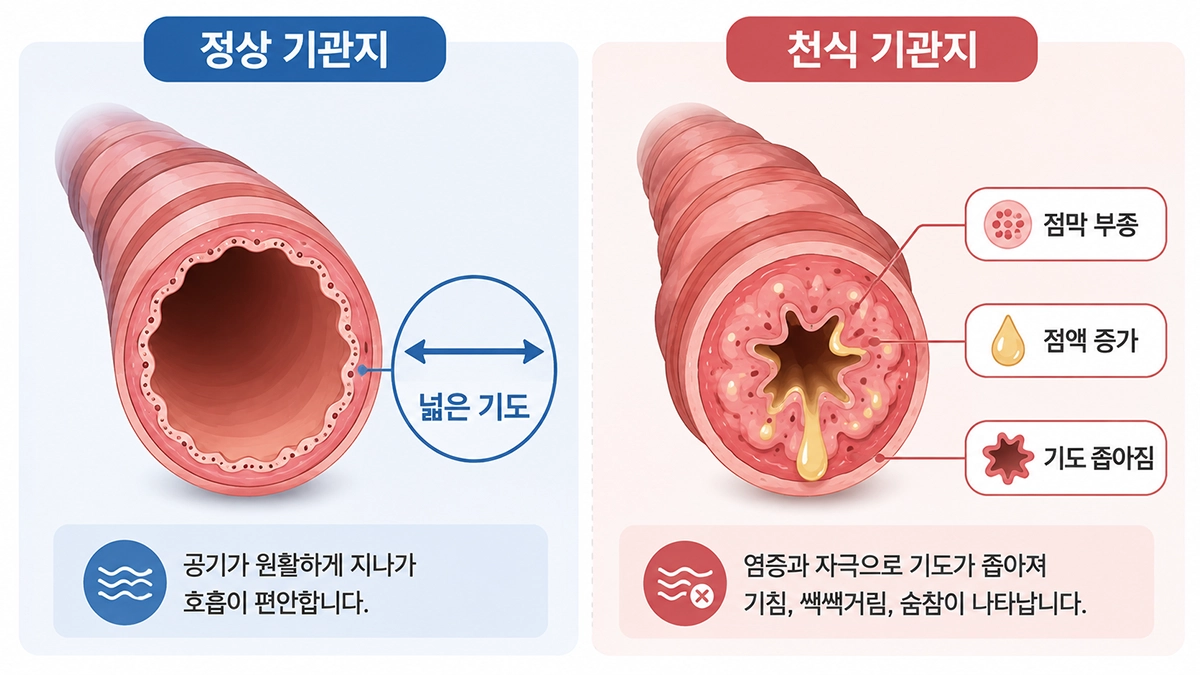 천식에서 정상 기관지와 염증으로 좁아진 기관지의 차이