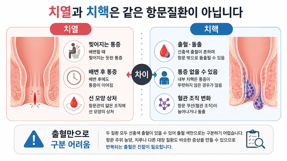 치열 증상과 치핵의 통증 및 출혈 차이를 비교한 인포그래픽