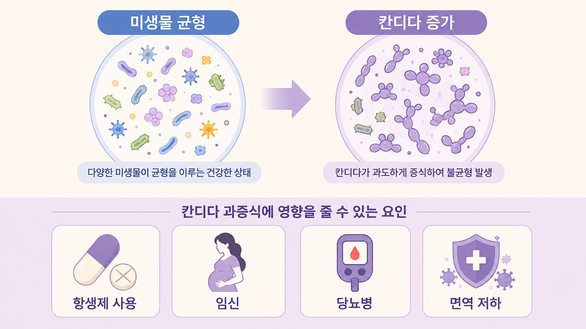 칸디다 질염과 관련된 항생제 사용, 임신, 당뇨병과 면역기능 저하 요인을 보여주는 인포그래픽
