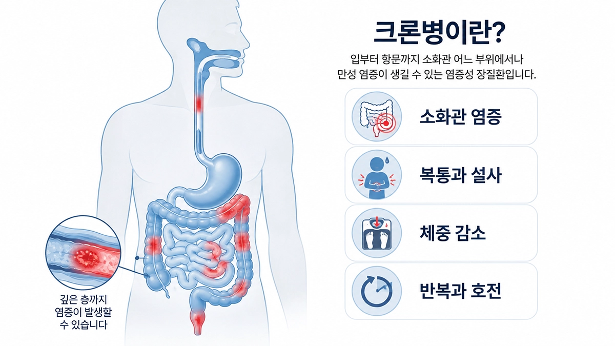 크론병이 소화관에 띄엄띄엄 염증을 일으키는 특징을 설명한 인포그래픽