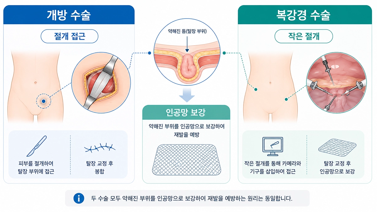 탈장 치료에 사용되는 개방 수술과 복강경 수술 및 인공망 보강을 비교한 인포그래픽