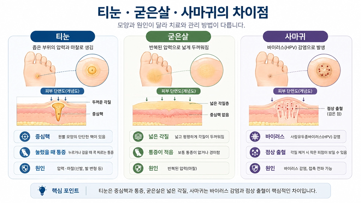 티눈과 굳은살 및 발바닥 사마귀의 특징과 차이를 비교한 인포그래픽