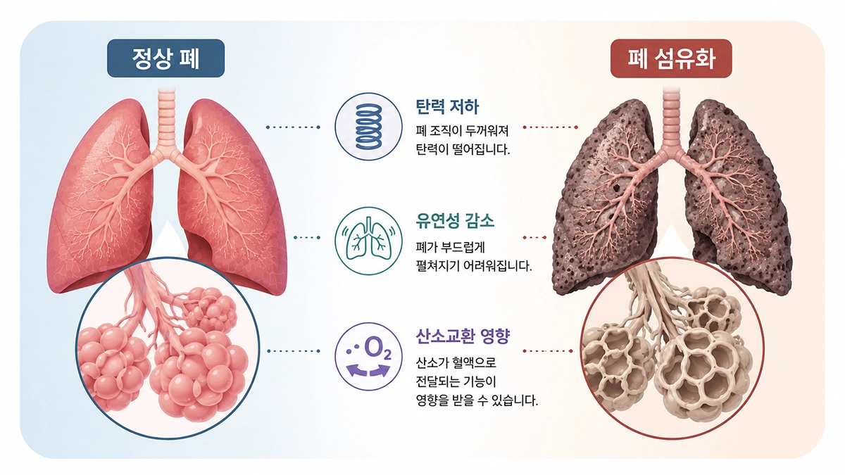 폐섬유화증으로 폐 조직이 두꺼워지고 탄력이 저하되는 변화를 보여주는 그림