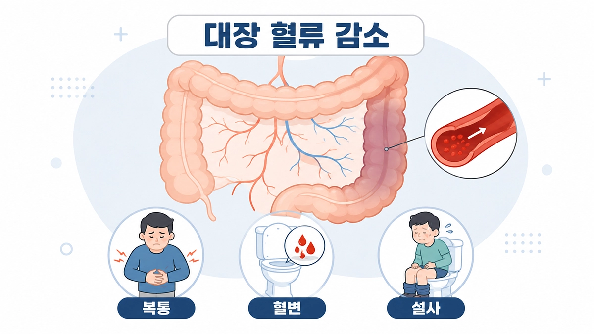 허혈성 대장염에서 대장 혈류 감소와 복통 혈변 설사를 설명하는 인포그래픽