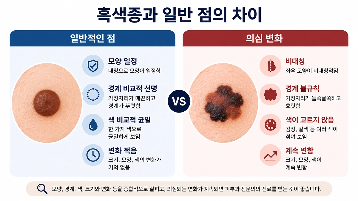 흑색종과 일반 점의 모양과 경계, 색 변화 차이를 비교한 인포그래픽